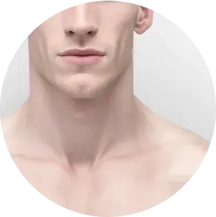 Fitzpatrick skin type I
