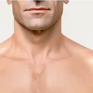 Fitzpatrick skin type II